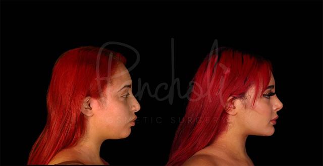 Neck Lift result at Pancholi Cosmetic Surgery in Las Vegas, NV