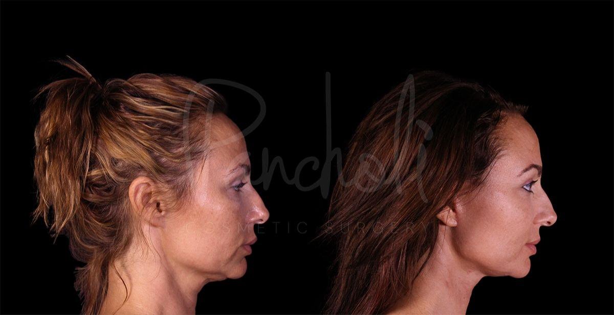 Pancholi Cosmetic Surgery neck lift result — Las Vegas, NV