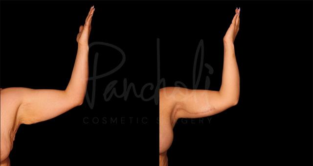 Thigh Lift result at Pancholi Cosmetic Surgery in Las Vegas, NV