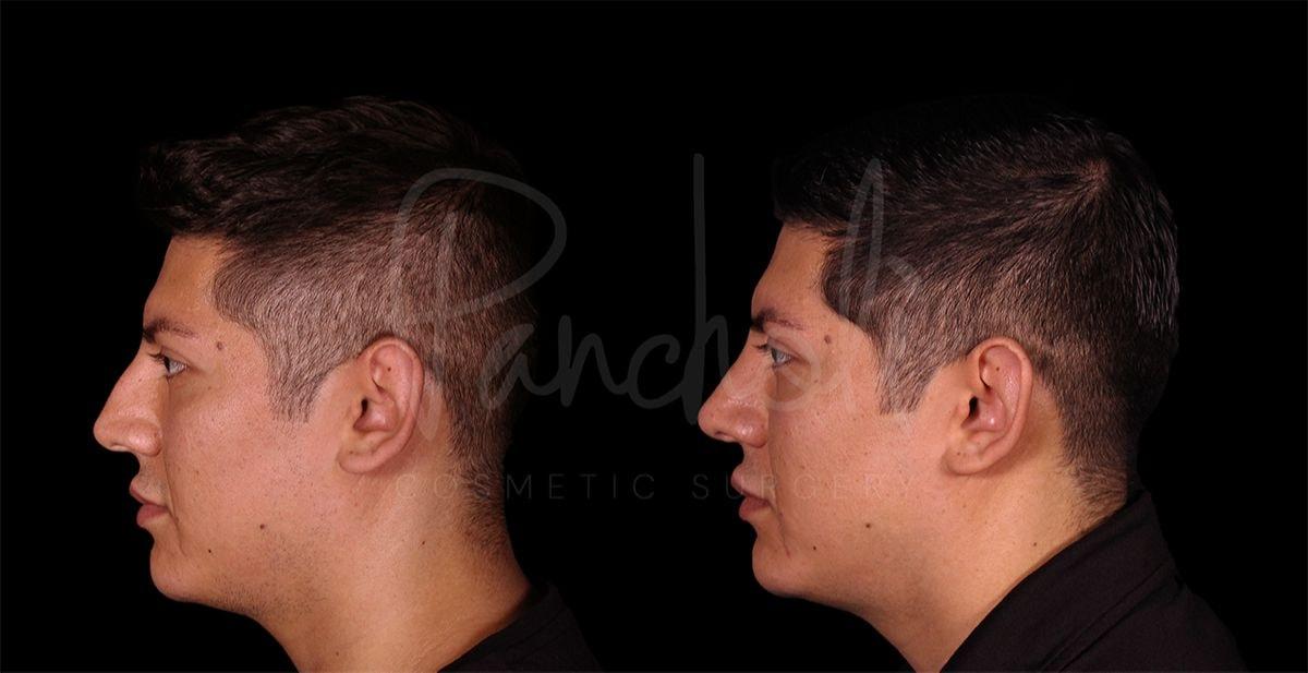 Pancholi Cosmetic Surgery rhinoplasty result — Las Vegas, NV