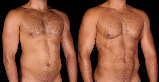 Liposuction result at Pancholi Cosmetic Surgery in Las Vegas, NV