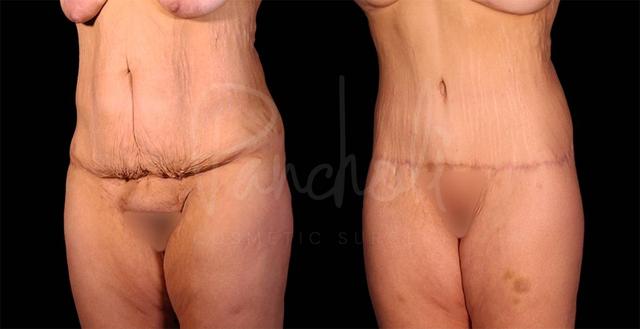 Arm Lift result at Pancholi Cosmetic Surgery in Las Vegas, NV
