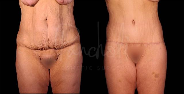Arm Lift result at Pancholi Cosmetic Surgery in Las Vegas, NV