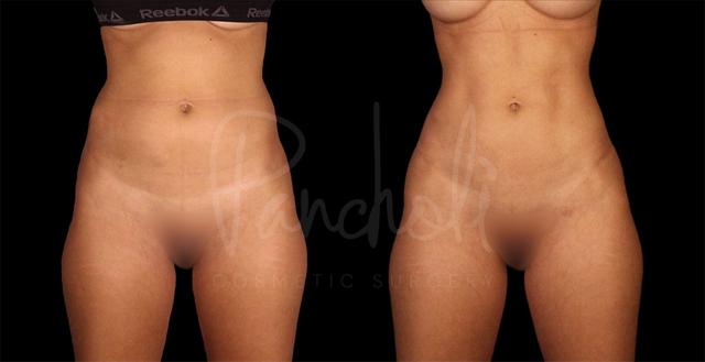 Liposuction result at Pancholi Cosmetic Surgery in Las Vegas, NV