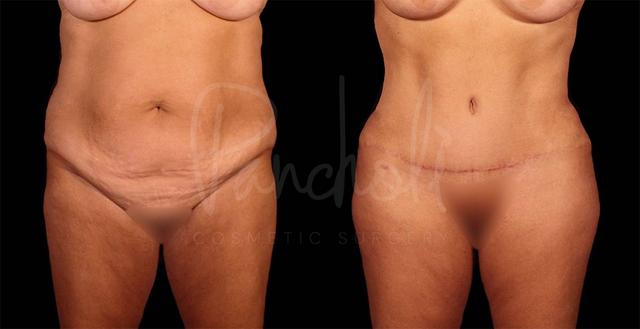 Tummy Tuck result at Pancholi Cosmetic Surgery in Las Vegas, NV