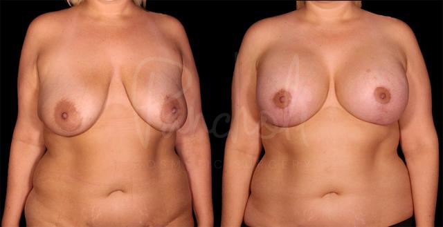 Breast Lift result at Pancholi Cosmetic Surgery in Las Vegas, NV