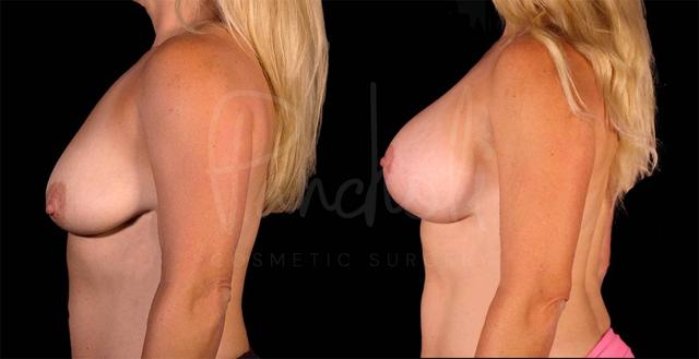 Breast Lift result at Pancholi Cosmetic Surgery in Las Vegas, NV