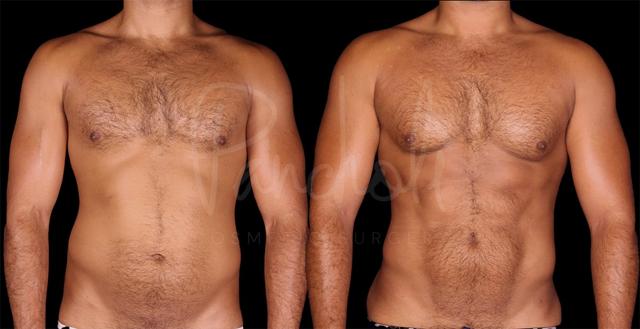 Liposuction result at Pancholi Cosmetic Surgery in Las Vegas, NV