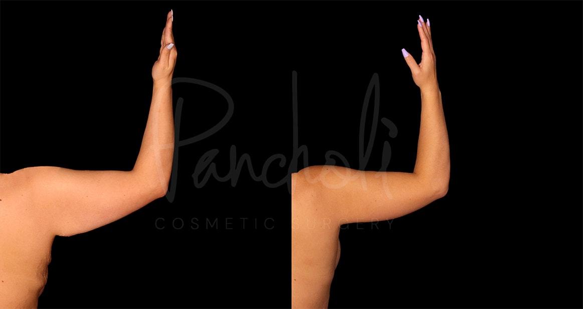 Pancholi Cosmetic Surgery arm lift result — Las Vegas, NV