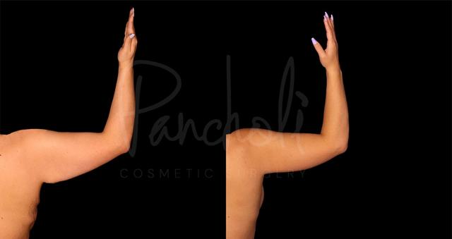 Thigh Lift result at Pancholi Cosmetic Surgery in Las Vegas, NV