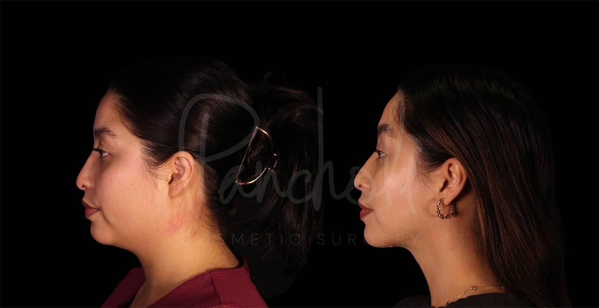 Pancholi Cosmetic Surgery neck lift result — Las Vegas, NV