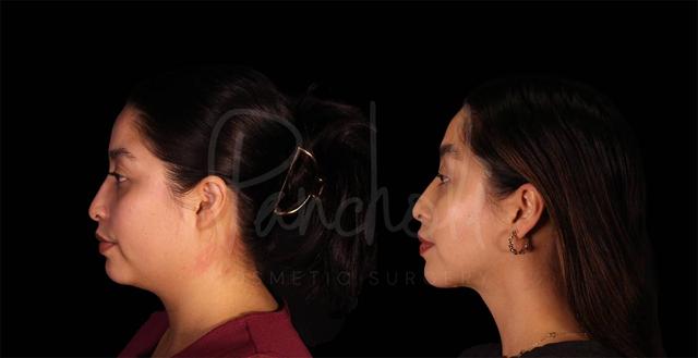 Neck Lift result at Pancholi Cosmetic Surgery in Las Vegas, NV