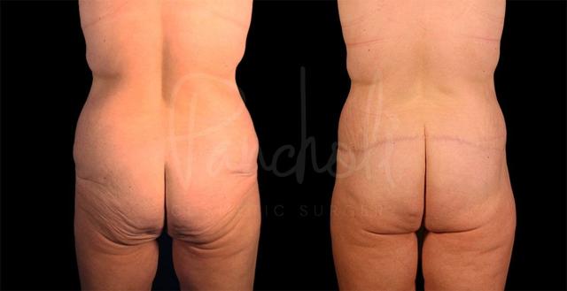 Arm Lift result at Pancholi Cosmetic Surgery in Las Vegas, NV