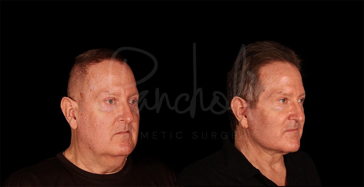 Pancholi Cosmetic Surgery facelift result — Las Vegas, NV