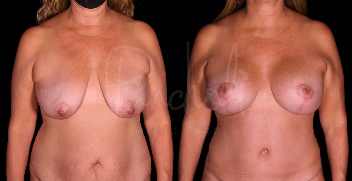 Pancholi Cosmetic Surgery breast lift result — Las Vegas, NV