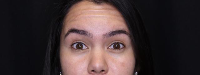 Botox before at Inside Out Aesthetics in Scottsdale, AZ