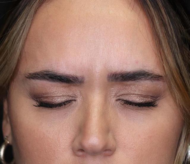 Botox after at Inside Out Aesthetics in Scottsdale, AZ