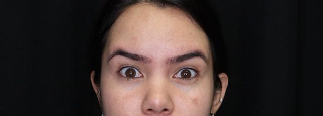 Botox after at Inside Out Aesthetics in Scottsdale, AZ