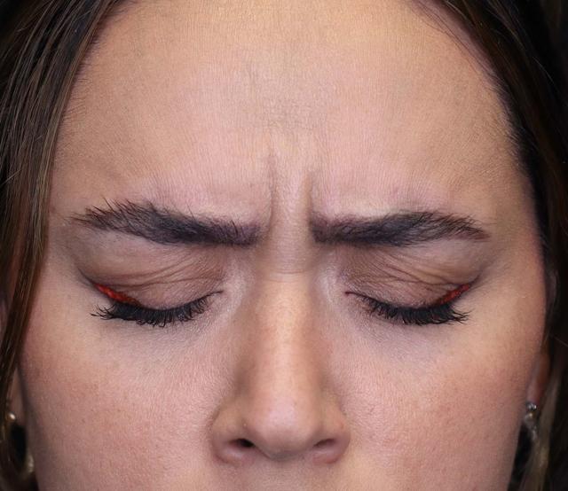 Botox before at Inside Out Aesthetics in Scottsdale, AZ