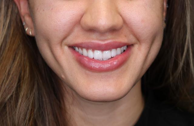 Lip Filler after at Inside Out Aesthetics in Scottsdale, AZ