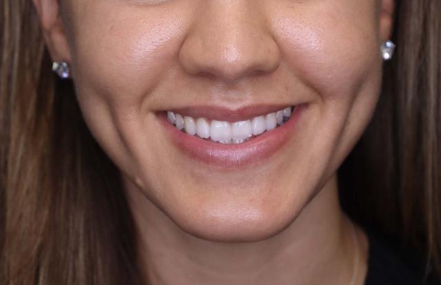 Lip Filler before at Inside Out Aesthetics in Scottsdale, AZ