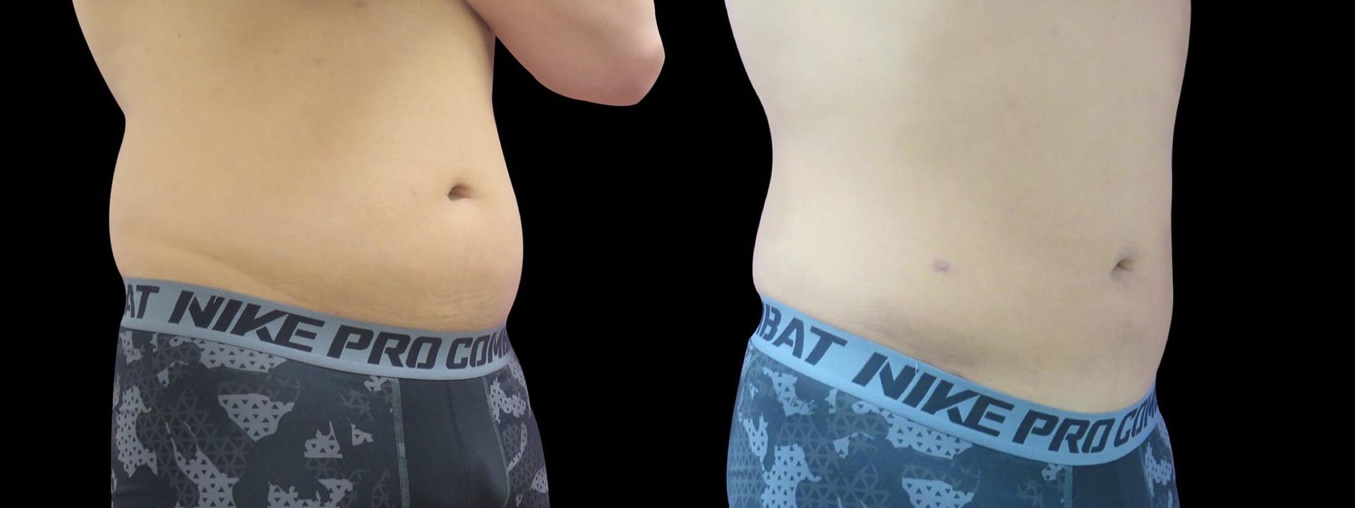 Blaine Plastic Surgery gynecomastia result — New York, NY
