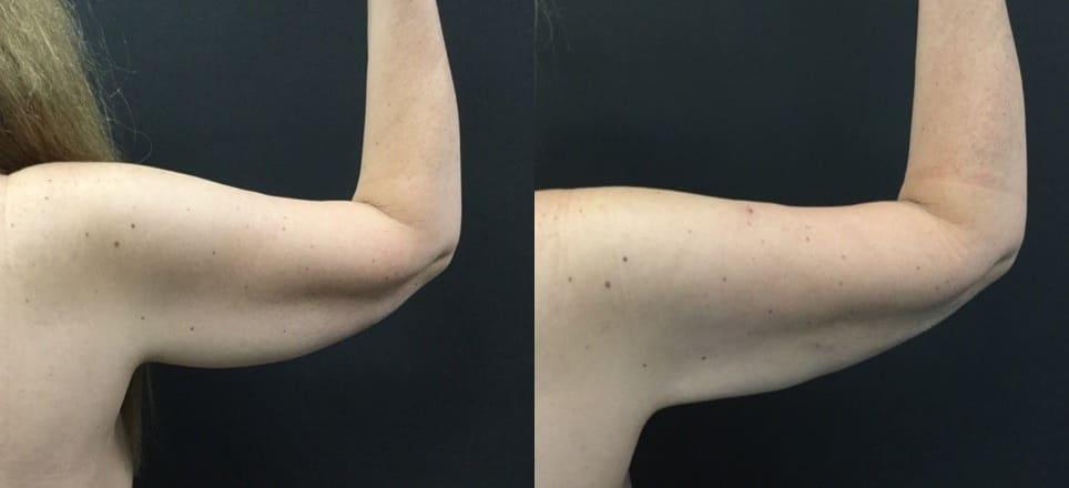 Blaine Plastic Surgery liposuction result — New York, NY