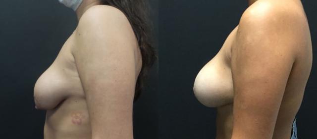 Breast Augmentation result at Blaine Plastic Surgery in New York, NY