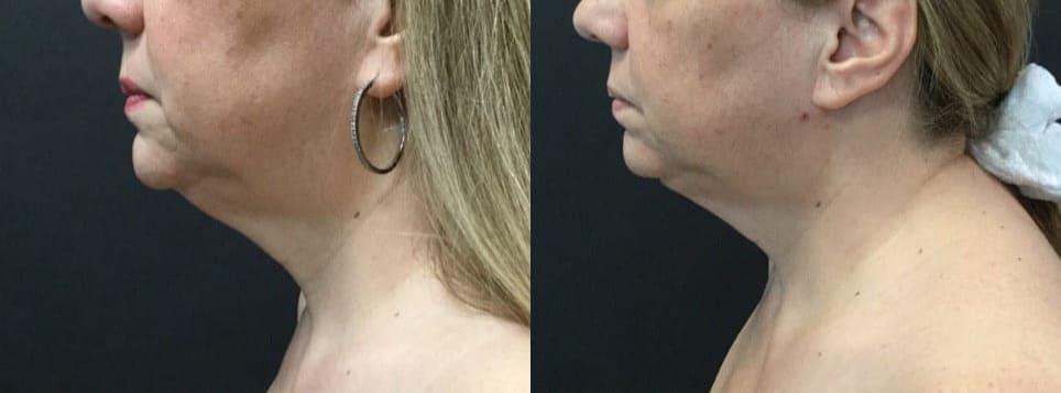 Blaine Plastic Surgery facelift result — New York, NY