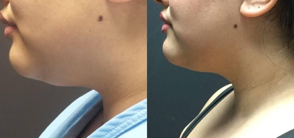 Blaine Plastic Surgery facelift result — New York, NY