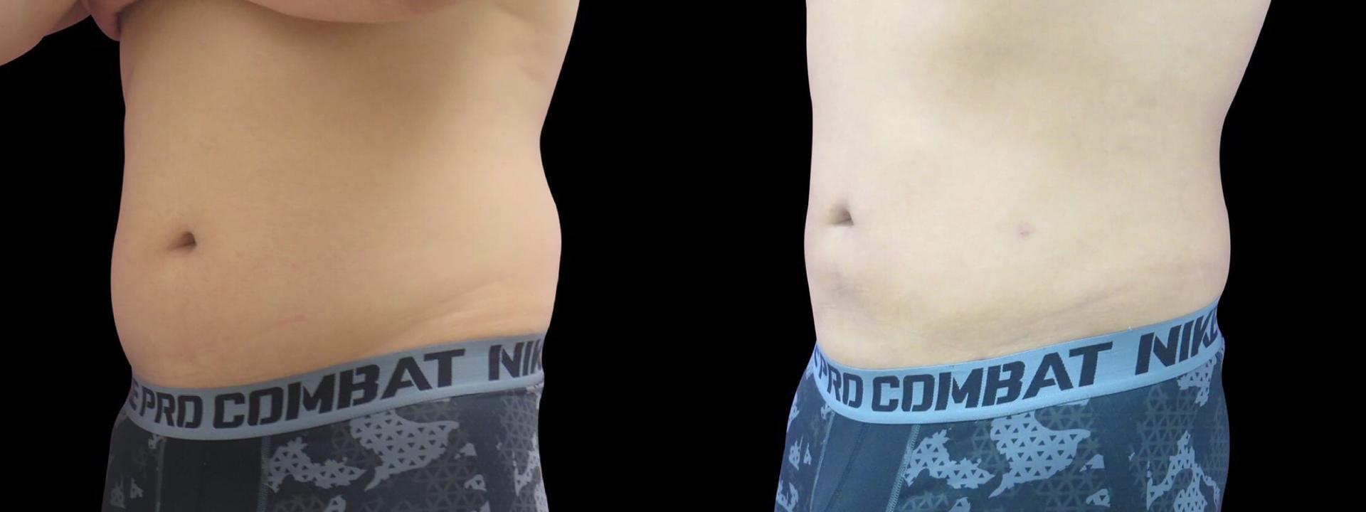 Blaine Plastic Surgery gynecomastia result — New York, NY
