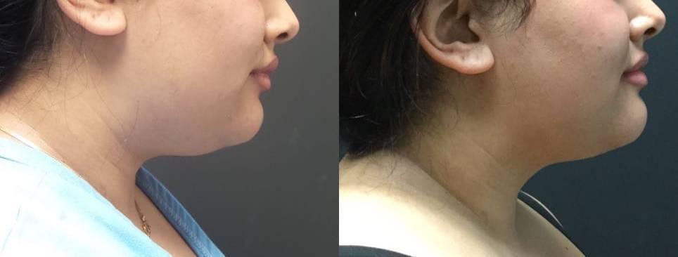 Blaine Plastic Surgery facelift result — New York, NY