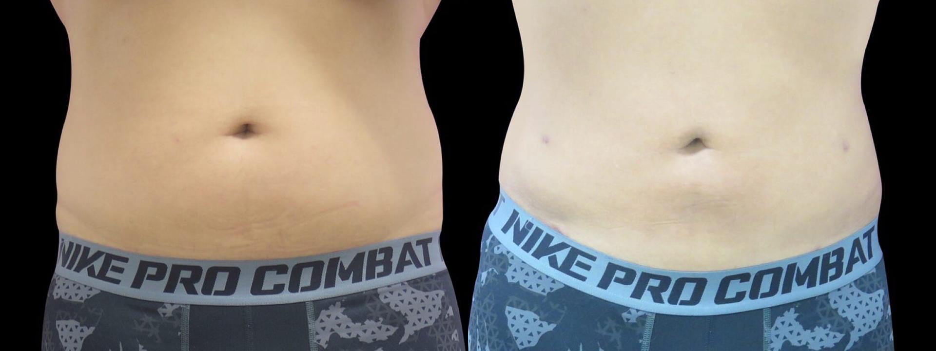 Blaine Plastic Surgery gynecomastia result — New York, NY