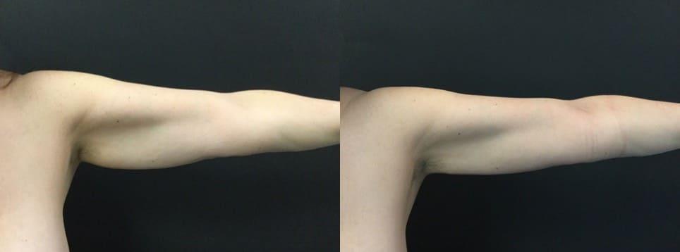 Blaine Plastic Surgery liposuction result — New York, NY