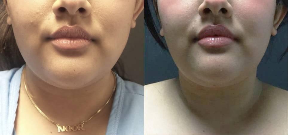 Blaine Plastic Surgery facelift result — New York, NY