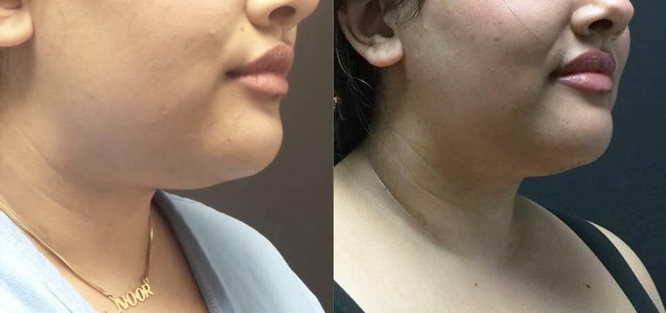 Blaine Plastic Surgery facelift result — New York, NY