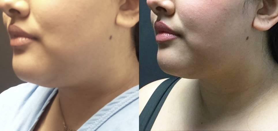 Blaine Plastic Surgery facelift result — New York, NY