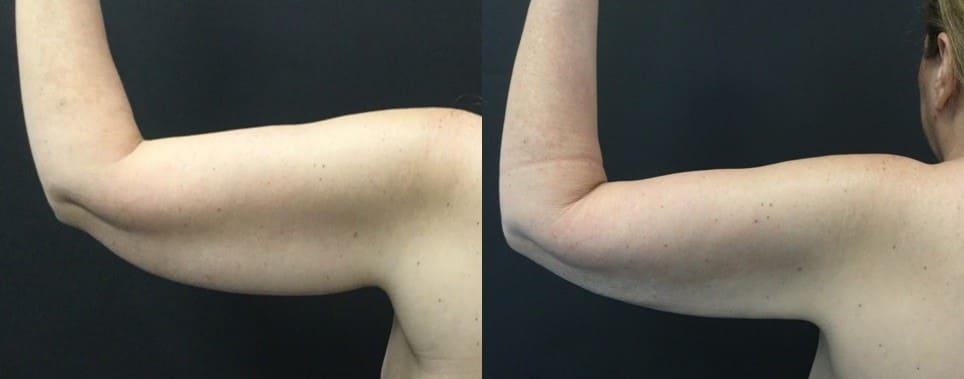 Blaine Plastic Surgery liposuction result — New York, NY