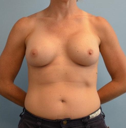 Ellsworth Plastic Surgery breast augmentation after — Houston, TX