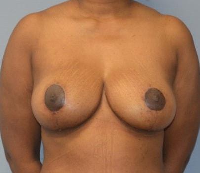 Ellsworth Plastic Surgery breast reduction after — Houston, TX
