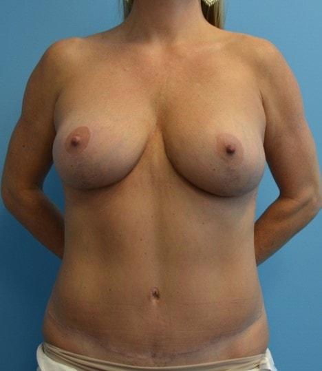 Ellsworth Plastic Surgery mommy makeover after — Houston, TX
