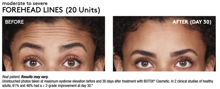 Renew Wellness & Aesthetics botox result — Oklahoma City, OK