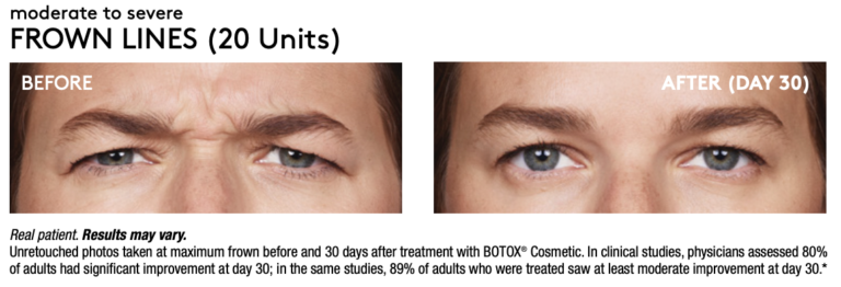 Renew Wellness & Aesthetics botox result — Oklahoma City, OK