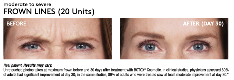 Renew Wellness & Aesthetics botox result — Oklahoma City, OK