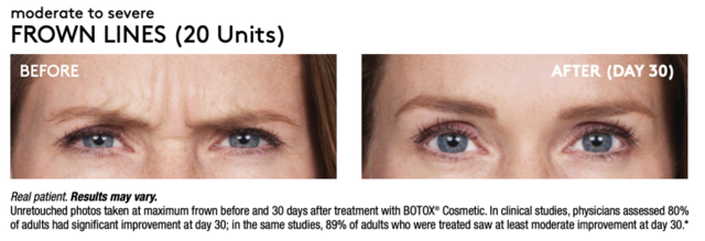 Botox result at Renew Wellness & Aesthetics in Oklahoma City, OK