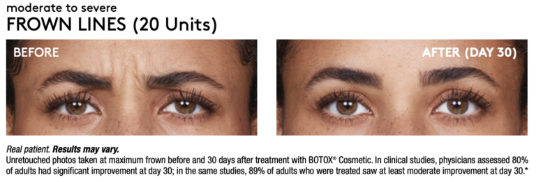 Renew Wellness & Aesthetics botox result — Oklahoma City, OK
