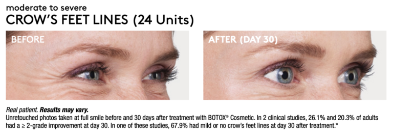 Renew Wellness & Aesthetics botox result — Oklahoma City, OK