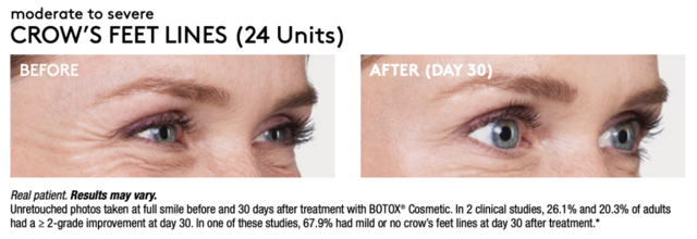 Botox result at Renew Wellness & Aesthetics in Oklahoma City, OK