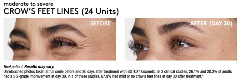 Renew Wellness & Aesthetics botox result — Oklahoma City, OK