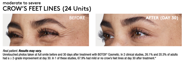 Botox result at Renew Wellness & Aesthetics in Oklahoma City, OK